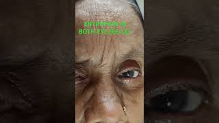 ENTROPION CASEOPHTHALMOLOGY PATIENT ENTROPIONCLINICAL CASE ENTROPIONEYELASHES PROBLEM [upl. by Nagad]