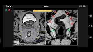 NBE MRI IN RECTAL CANCER BASICS TO RECENT ADVANCES DR SUMAN KUMAR [upl. by Oika771]