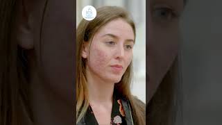 Dermabrasion in Turkey skincare acnescars [upl. by Hanleigh]