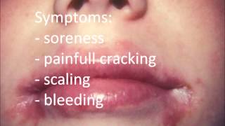 Angular Cheilitis Treatment permanent  How to Cure Angular Cheilitis in 12 hours [upl. by Ellynad]