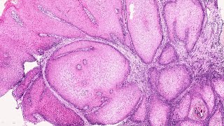 OPath Verrucous Hyperplasia vs Verrucous Carcinoma  by Dr Mithilesh Chandra [upl. by Rosenfeld]