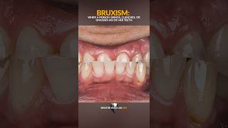 The Best Small TeethBruxism Solution [upl. by Eus275]