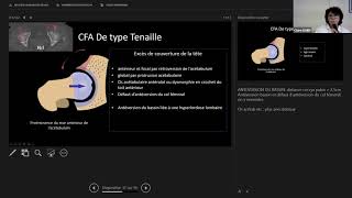 Catherine CYTEVAL Le conflit fémoro acétabulaire [upl. by Farleigh]