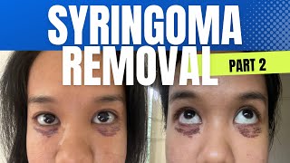 Syringoma Removal Part 2 Price Clinic Update etc [upl. by Rodina]