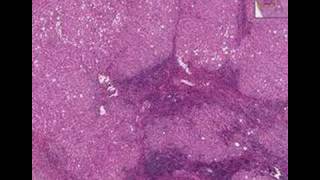 Histopathology LiverChronic active hepatitis cirrhosis [upl. by Yrrek13]