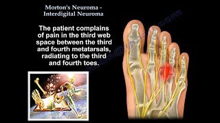 Mortons Neuroma  Interdigital Neuroma  Everything You Need To Know  Dr Nabil Ebraheim [upl. by Adnoyek]