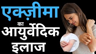 ECZEMA  Causes Symptoms Types Home Remedies amp Ayurvedic Treatment [upl. by Parette]