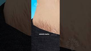 Why Do Stretch Marks Really Happen 😱 shorts viralvideo  Creativelearning3d [upl. by Zat]