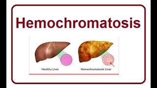 Haemochromatosis  The Silent Iron Overlod 2024 [upl. by Initsed334]