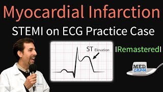 Myocardial Infarction  STEMI on ECG  Practice EKG [upl. by Quigley]