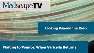 Looking Beyond the Rash  Waiting to Pounce When Varicella Returns  MedscapeTV [upl. by Niel]