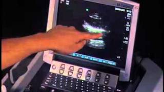 How to Pneumothorax Evaluation with Ultrasound [upl. by Hereld695]