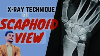 scaphoid view x ray  procedure  process [upl. by Even]