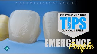 diastema closure technique tips [upl. by Eidnam]