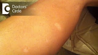 What causes sudden appearance of white round spots on legs  Dr Sudheendra Udbalker [upl. by Aile]