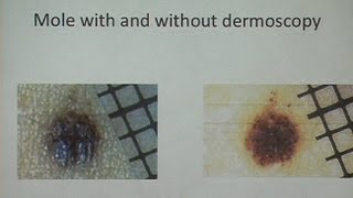 Melanoma and Nonmelanoma Skin Cancer [upl. by Eirotal967]