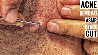 ASMR BEARD SHAVE And Subcutaneous acne removal • Barber Massage • Sleep Asmr [upl. by Dearr]