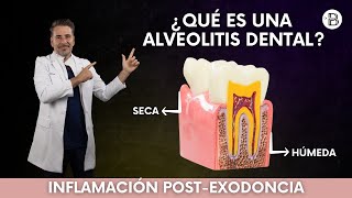 ALVEOLITIS dental Causas y tratamiento🦷 [upl. by Don]