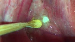 Slow Motion Tonsil Stone Removal [upl. by Reppiks]