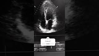 echocardiography spotfinding echofinding [upl. by Danczyk]