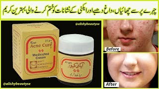 Best Acne Cream Acne Cure Medicated Creams Review 100 Results Urdu Hindi [upl. by Obel]