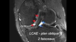 Ligament croise anterieur  normal  IRM 3D [upl. by Hnib]