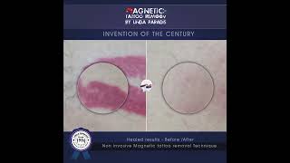 Magnetic Tattoo Removal Before amp After  Noninvasive  No scars  completely tattoo removal [upl. by Dupin]