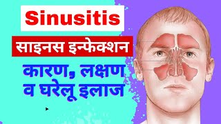 Sinusitis in hindi  साइनस के कारण लक्षण व इलाज  sinus infection  common ENT disease [upl. by Wells275]