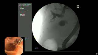 Hilar Cholangiocarcinoma Bismuth type 2  Palliative treatment with bare SEM 10x100mm to right duct [upl. by Zetrac]