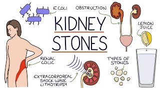 Understanding Kidney Stones [upl. by Si900]