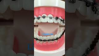 How to Remove ligature from ortho bracesFixed BracesOrthodontic Treatment🦷 [upl. by Adnohs]