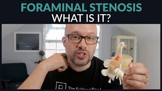 What is Foraminal Stenosis [upl. by Annauj32]