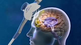 How Does Transcranial Magnetic Stimulation work [upl. by Bradan110]