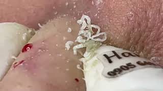 Popping Blackheads from Nose with Haris Beauty  2022 [upl. by Gilemette]