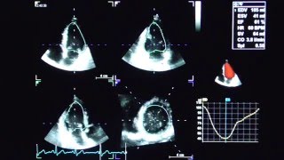 4D AUTO LVQ STRAIN WITH LV AREA [upl. by Hendrick]