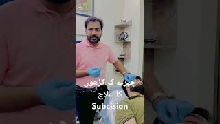 Subcision for acne scars dermatology fullbodywhiteningtreatment doctor hospital medicaltherapy [upl. by Wallford]