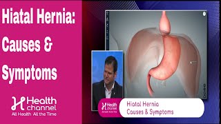 Hiatal Hernia Causes amp Symptoms [upl. by Kalle]