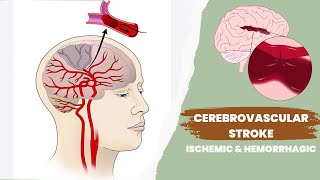 Cerebrovascular accident or stroke  Ischemic and hemorrhagic [upl. by Asoj465]