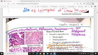 Differentiation and Anaplasia Carcinoma in situ  neoplasia part 2 [upl. by Gerald]