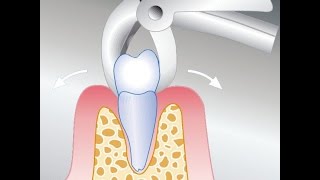 für Zahnärzte Zahn ziehen [upl. by Adlin745]
