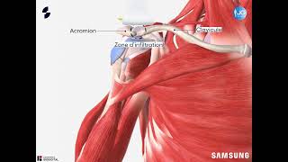 Acromioclaviculaire infiltration échoguidée [upl. by Martino439]