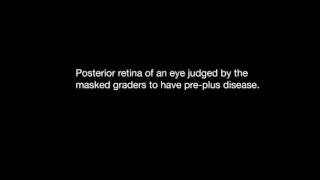 Predictive Value of Preplus Disease in Retinopathy of Prematurity Part 2 [upl. by Perceval]