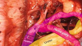 Laparoscopic Review of Internal Iliac Artery [upl. by Gladine345]