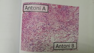 Schwannoma  SPECIAL PATHOLOGY [upl. by Harihat]