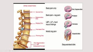 Hernia Nukleus Pulposus HNP [upl. by Elletnohs376]