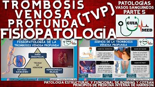 TROMBOSIS VENOSA PROFUNDA FISIOPATOLOGÍA  GuiaMed [upl. by Nial]