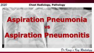 Aspiration Pneumonia vs Aspiration Pneumonitis [upl. by Fredia]