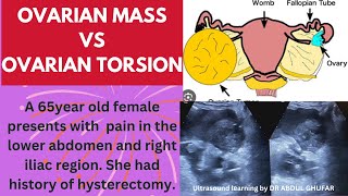 Ovarian cancer ultrasound  ovarian tumour ultrasound  ovarian torsion usg ovarian cancer symptoms [upl. by Atilek]