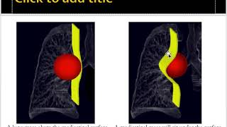 Mediastinal masses approach [upl. by Etteneg]