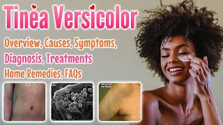 Tinea versicolor overview causes sign and symptoms diagnosis treatment home remedies and FAQs [upl. by Namrej]